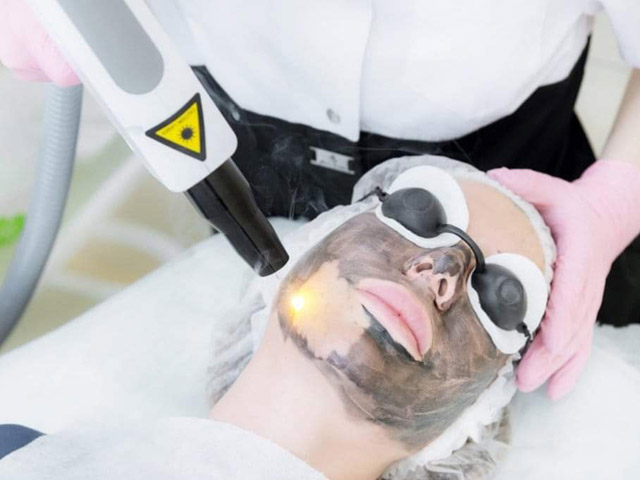 Carbon Laser Peeling